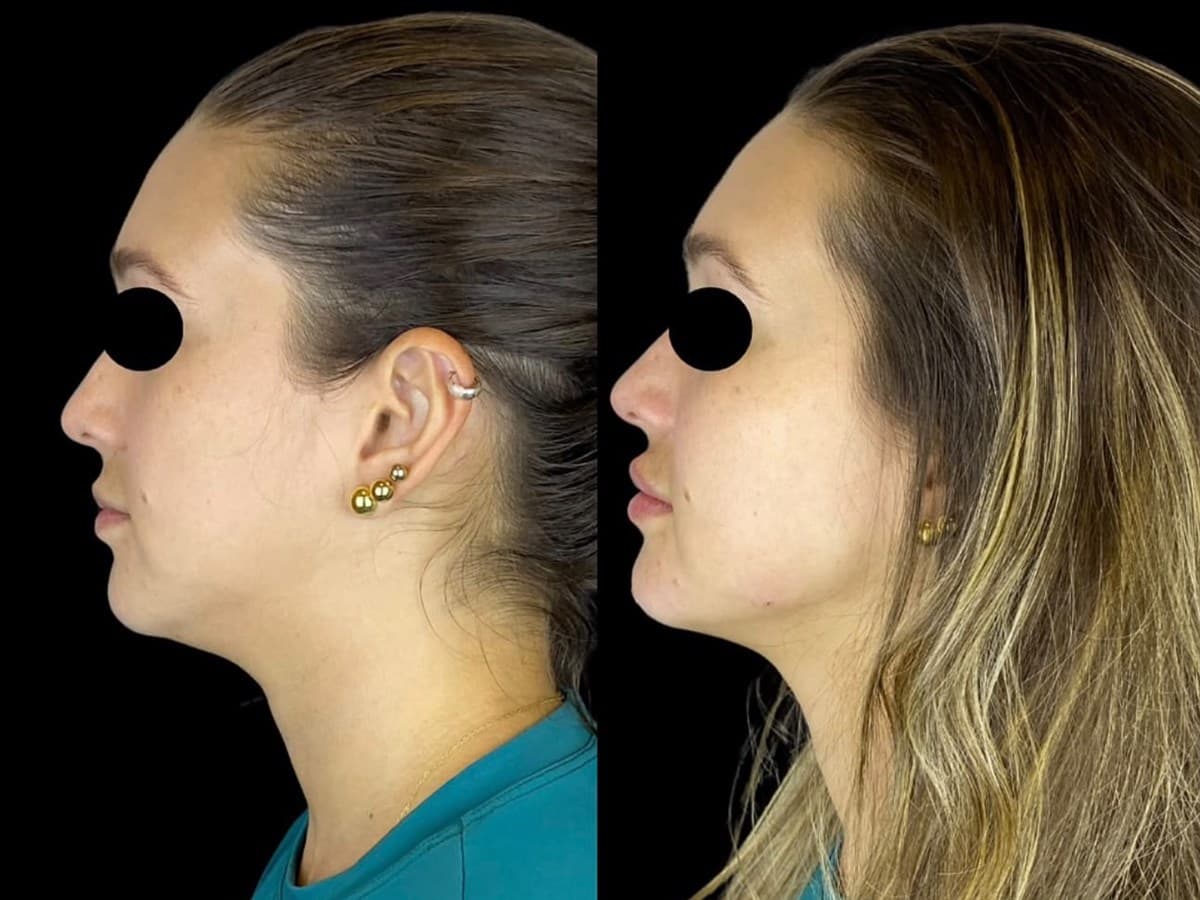 Melhora de Proporção Facial