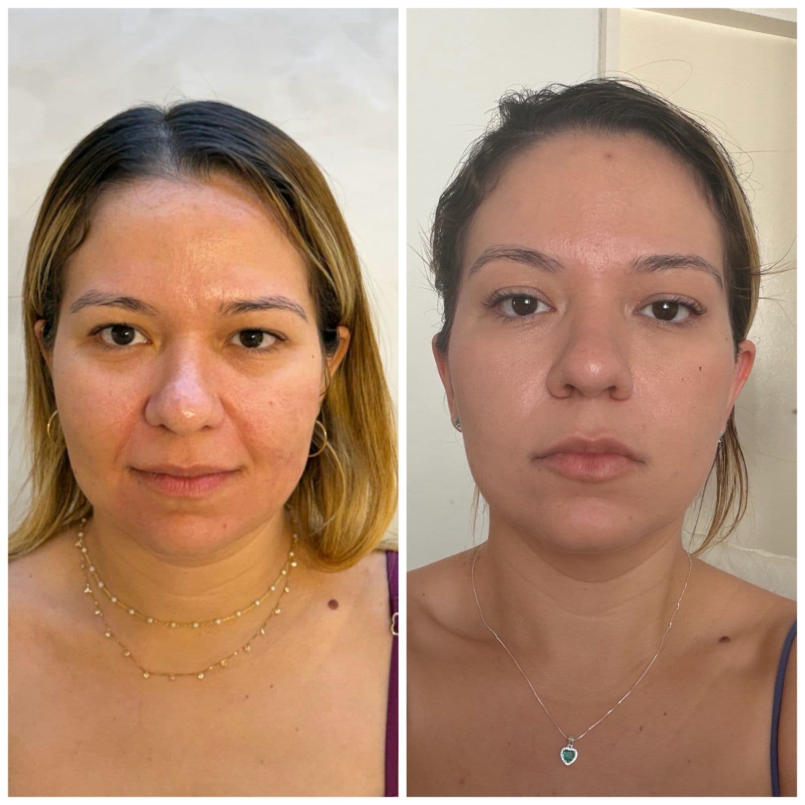 Harmonização Facial
