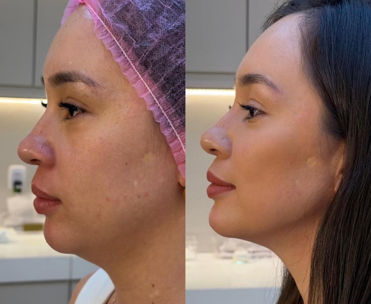 Harmonização Facial